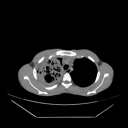 Cerebral tuberculoma (Radiopaedia 80829-94318 Axial non-contrast 21).jpg