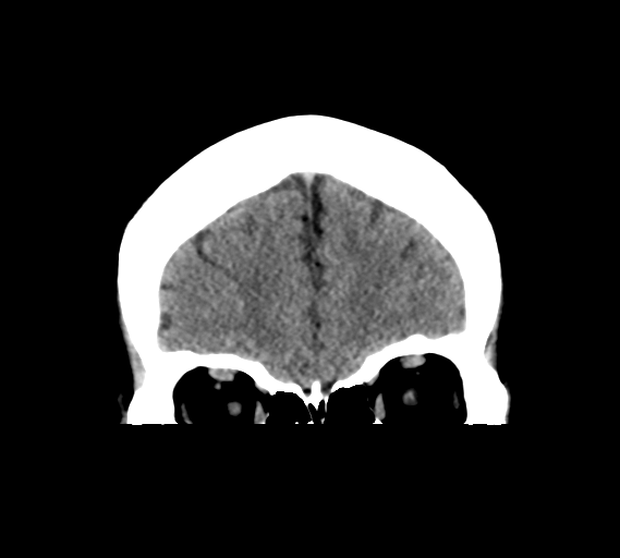 File:Cerebral venous infarct related to dural venous sinus thromboses (Radiopaedia 35292-36804 Coronal non-contrast 7).png