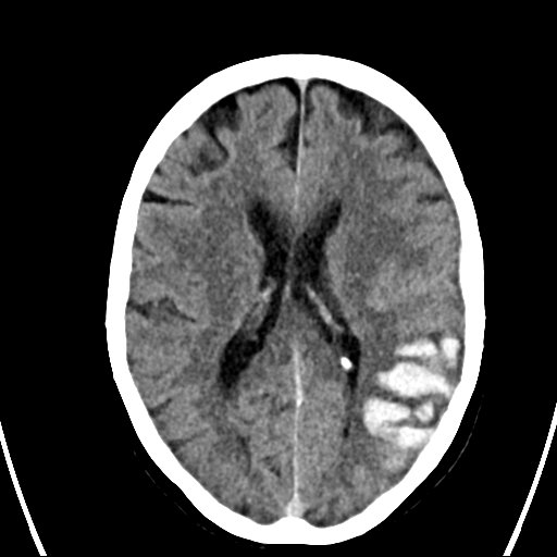 File:Cerebral venous infarction with hemorrhage (Radiopaedia 65343-74381 Axial non-contrast 15).jpg