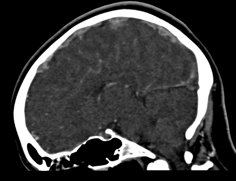 Cerebral venous sinus thrombosis (Radiopaedia 59224-66646 Sagittal C+ delayed 29).jpg