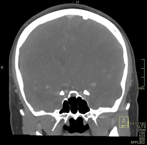 Cerebral venous sinus thrombosis (Radiopaedia 91329-108965 Coronal venogram 37).jpg