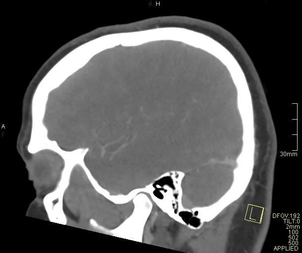 File:Cerebral venous sinus thrombosis (Radiopaedia 91329-108965 Sagittal venogram 18).jpg