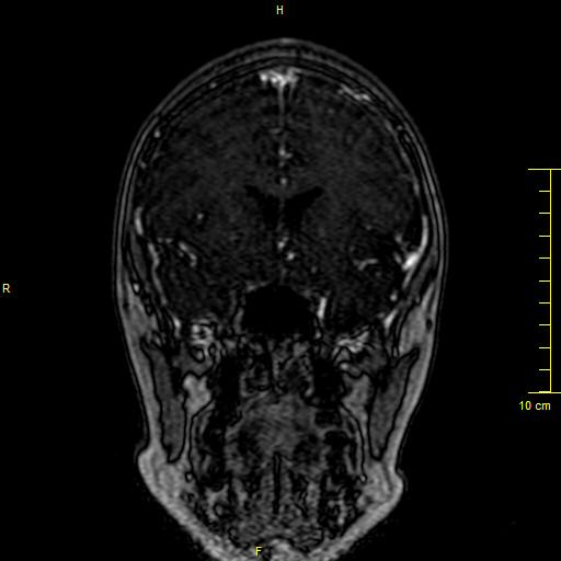 Cerebral venous thrombosis (Radiopaedia 23288-23351 MRV 37).JPG