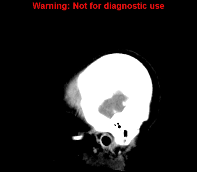 File:Cerebral venous thrombosis (Radiopaedia 37224-38992 B 3).jpg