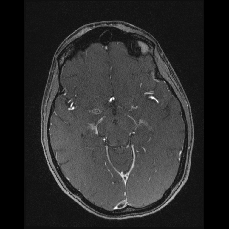 Cerebral venous thrombosis (Radiopaedia 45678-49854 Axial MRV 30).jpg