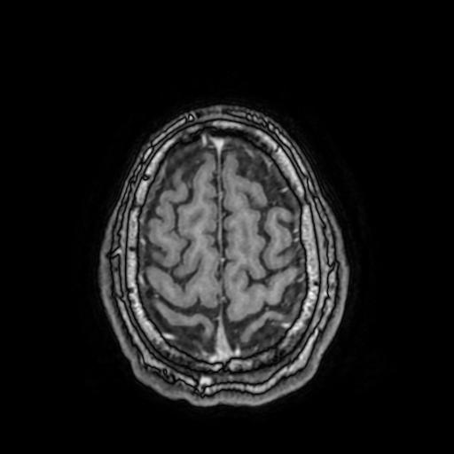 File:Cerebral venous thrombosis with secondary intracranial hypertension (Radiopaedia 89842-106957 Axial T1 C+ 145).jpg