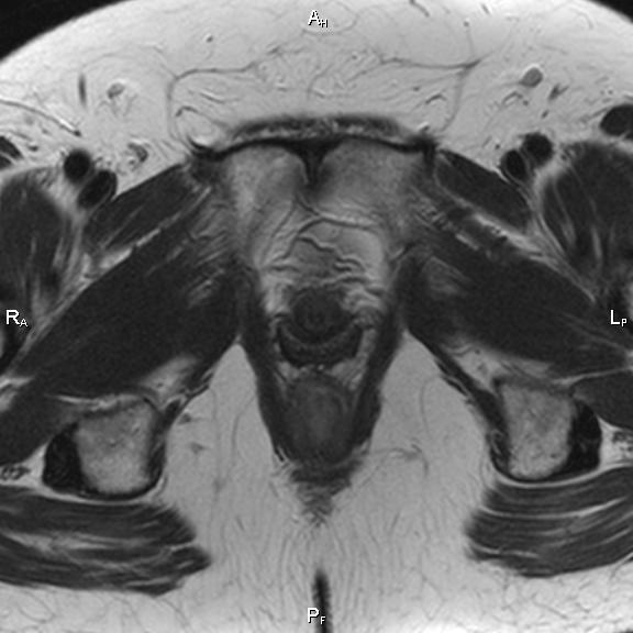 File:Cervical adenocarcinoma (Radiopaedia 65011-73985 Axial T2 10).jpg