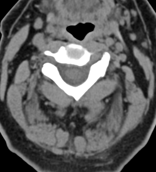 File:Cervical canal stenosis - OPLL and osteophytes (Radiopaedia 47329-51910 Axial non-contrast 21).png