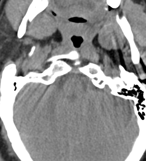 Cervical canal stenosis due to ossification of the posterior longitudinal ligament (Radiopaedia 47260-51823 Axial non-contrast 7).png