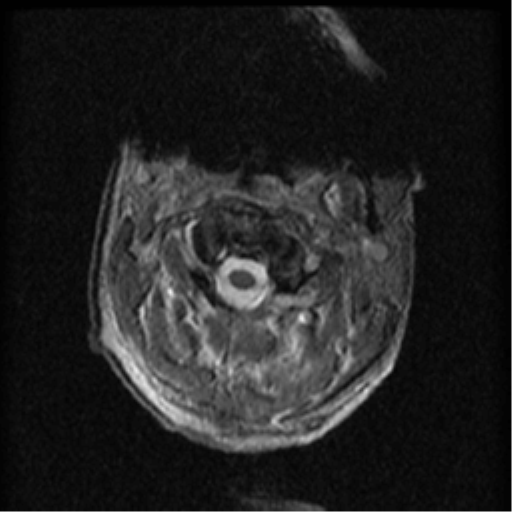 Cervical canal stenosis with cord compression (Radiopaedia 34114-35374 Axial Gradient Echo 87).png