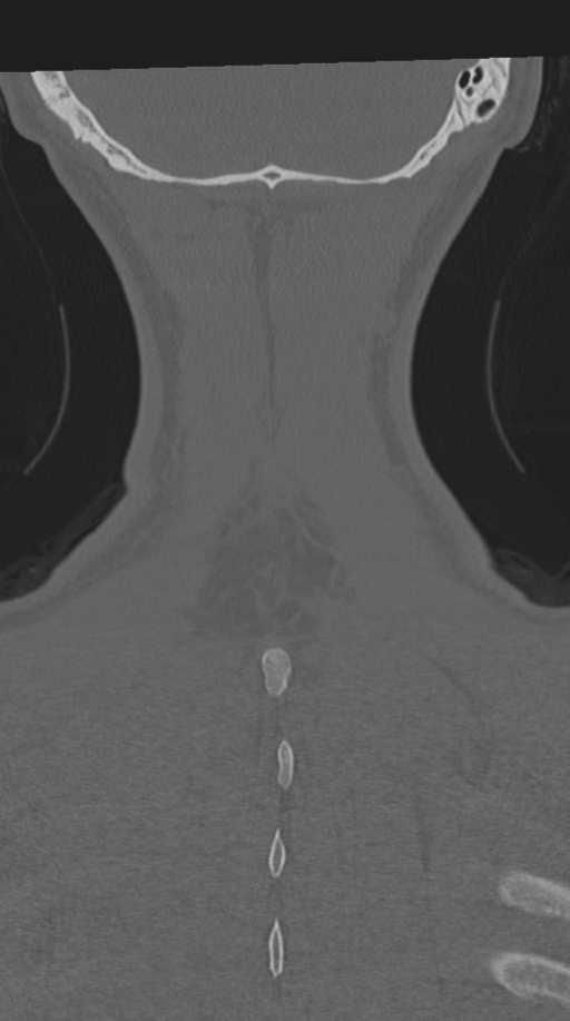 Cervical intercalary bone (Radiopaedia 35211-36748 Coronal bone window 73).png