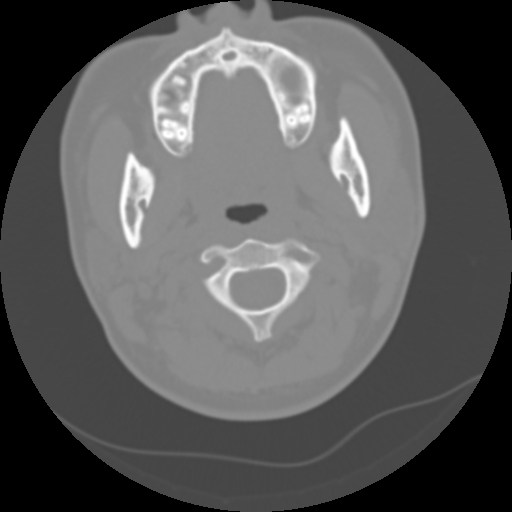 File:Cervical rib (Radiopaedia 71110-81363 Axial non-contrast 21).jpg