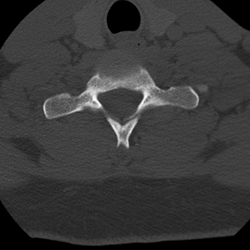 Cervical schwannoma (Radiopaedia 57979-64974 Axial bone window 39).png
