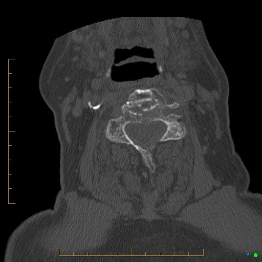 Cervical spine fracture - ankylosing spondylitis (Radiopaedia 76835-88706 Axial bone window 104).jpg