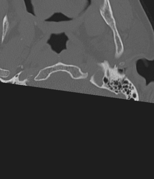 Cervical spine fracture in the setting of ankylosis (Radiopaedia 37038-38715 Axial bone window 4).png