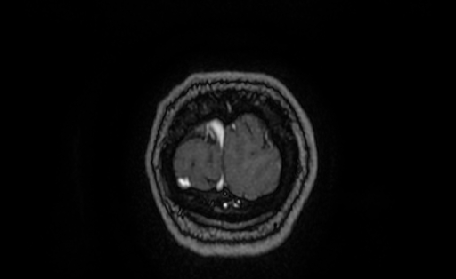Cervical spondylodiscitis and calvarial hemangioma (Radiopaedia 64317-73103 Coronal T1 C+ 73).jpg