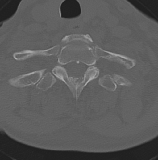 Cervical spondylolysis (Radiopaedia 49616-54811 Axial bone window 46).png