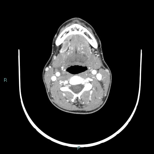 Cervical thymic cyst (Radiopaedia 88632-105335 B 68).jpg