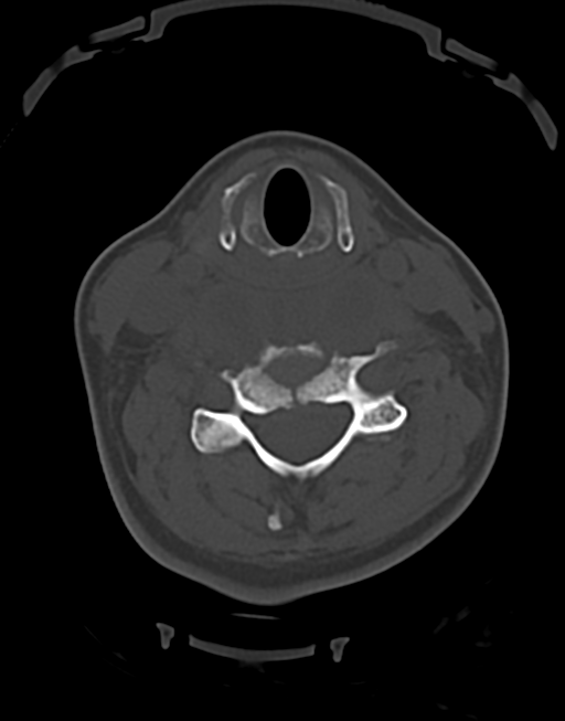 Cervical tuberculous spondylitis (Radiopaedia 39149-41365 Axial bone window 30).png