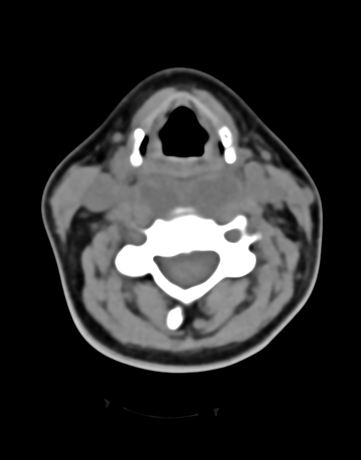 Cervical tuberculous spondylitis (Radiopaedia 39149-41365 Axial non-contrast 25).png