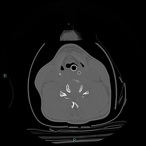 File:Cervical vertebral burst fracture (Radiopaedia 37420-39258 Axial bone window 16).jpg
