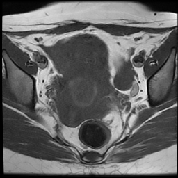 File:Cesarean scar ectopic pregnancy (Radiopaedia 77286-89362 Axial T1 14).jpg
