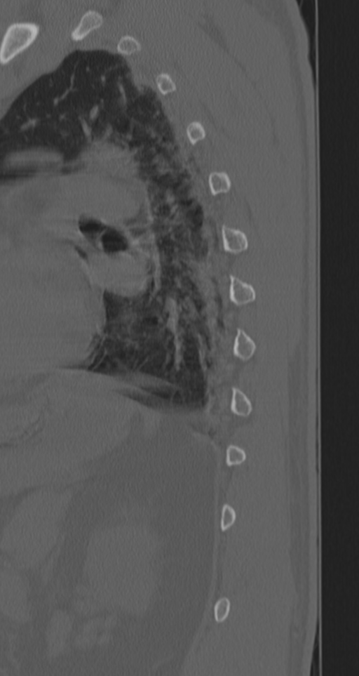 Chance fracture (Radiopaedia 33854-35020 Sagittal bone window 17).png