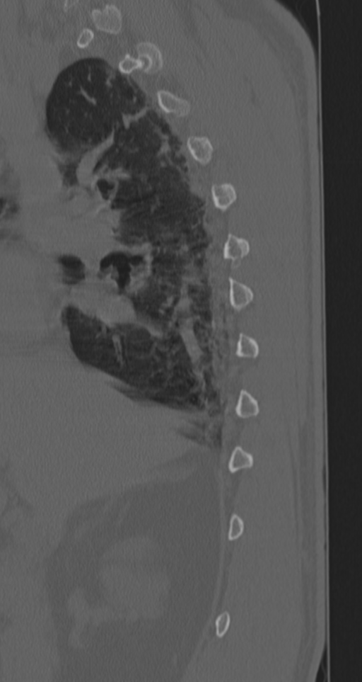 Chance fracture (Radiopaedia 33854-35020 Sagittal bone window 68).png
