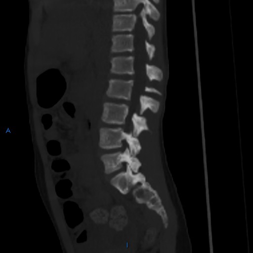 File:Chance fracture with duodenal and pancreatic lacerations (Radiopaedia 43477-50042 Sagittal bone window 8).jpg