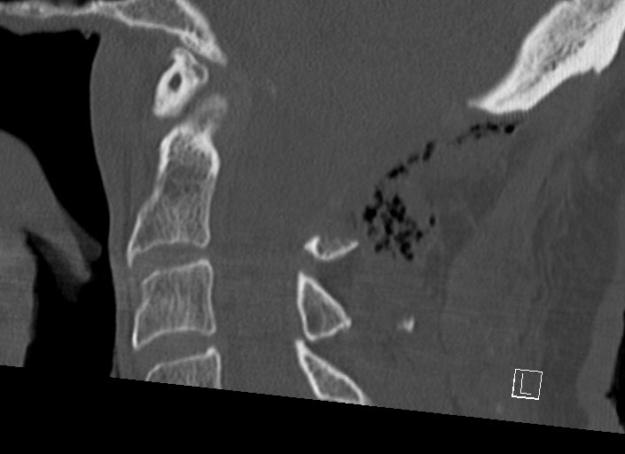 Chiari I malformation with a symptomatic syrinx of the posterolateral medulla oblongata (Radiopaedia 42573-45707 A 28).jpg