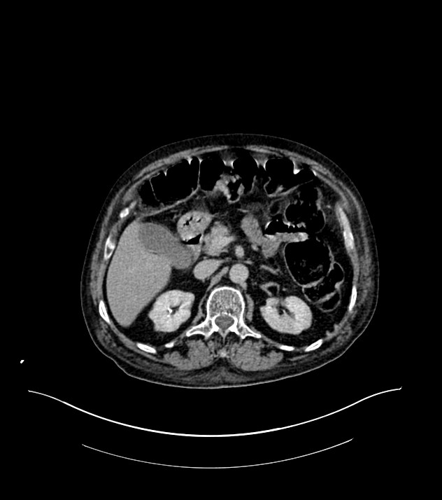 Cholangiocarcinoma with cerebral metastases (Radiopaedia 83519-98629 Axial C+ delayed 38).jpg