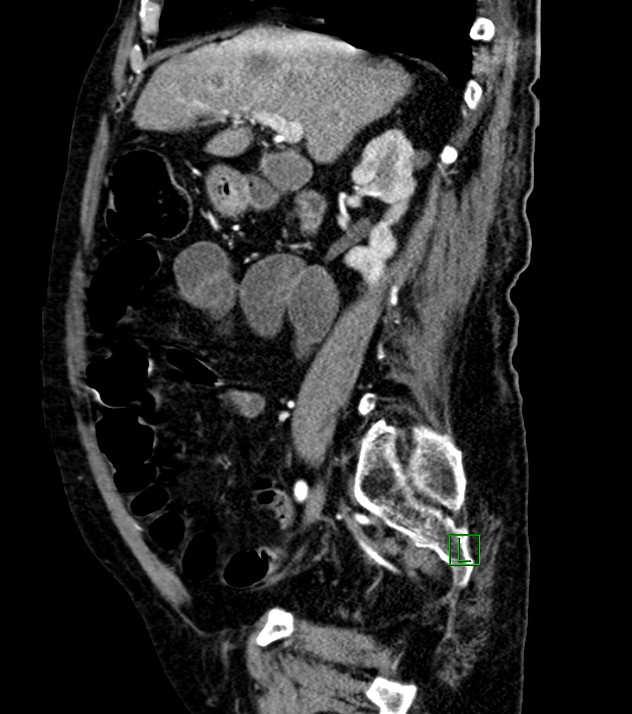 Cholangiocarcinoma with cerebral metastases (Radiopaedia 83519-98629 F 77).jpg