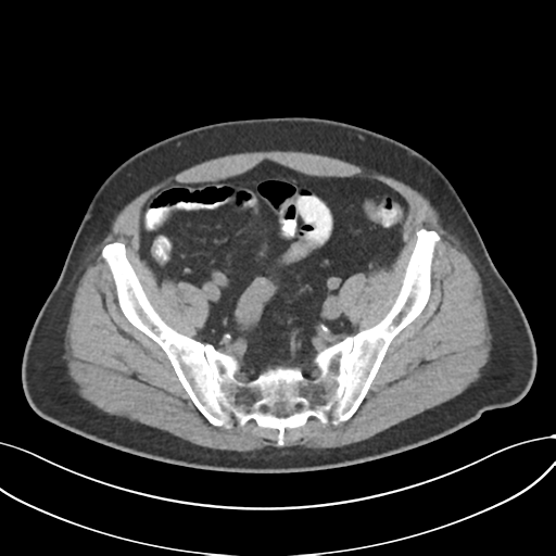 Cholecystitis with focal perforation and hepatic abscess (Radiopaedia 37189-38945 Axial non-contrast 68).png