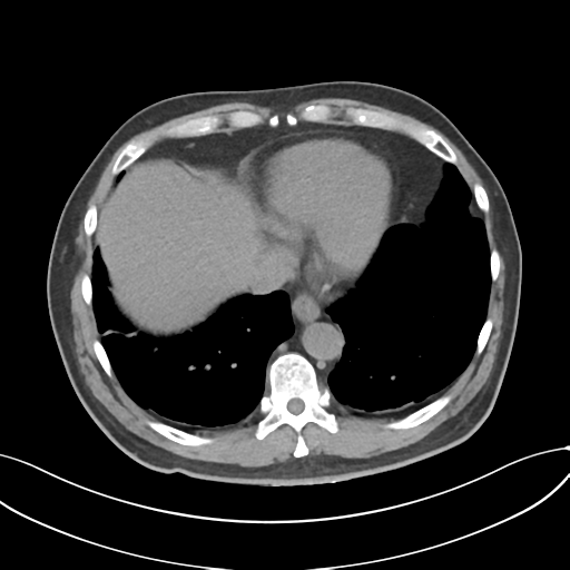 Cholecystitis with focal perforation and hepatic abscess (Radiopaedia 37189-38945 Axial non-contrast 9).png