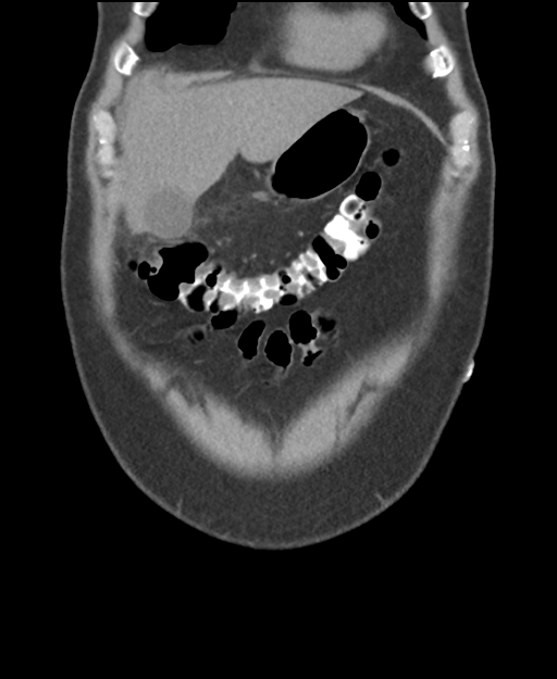 Cholecystitis with focal perforation and hepatic abscess (Radiopaedia 37189-38945 Coronal non-contrast 11).png