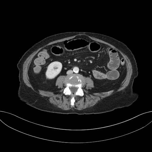 Cholecystoduodenal fistula due to calculous cholecystitis with gallstone migration (Radiopaedia 86875-103077 D 47).jpg
