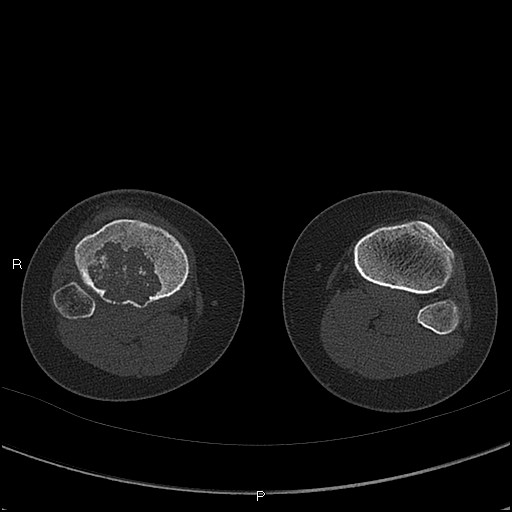 File:Chondroblastoma (Radiopaedia 62721-71030 Axial bone window 71).jpg
