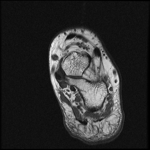 File:Chondroblastoma - midfoot (Radiopaedia 64831-73765 Short axis T1 4).jpg