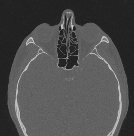 Chondrosarcoma (clivus) (Radiopaedia 46895-51425 Axial bone window 30).png