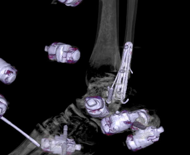 File:Chopart fracture (Radiopaedia 35347-36861 3D MPR bone window 9).jpg