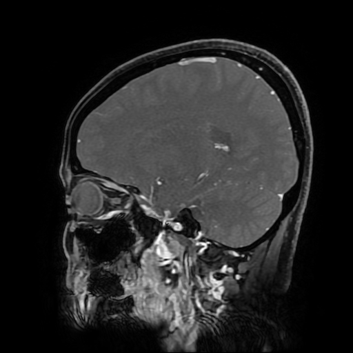 File:Chordoid glioma of third ventricle (Radiopaedia 91612-109340 F 134).jpg