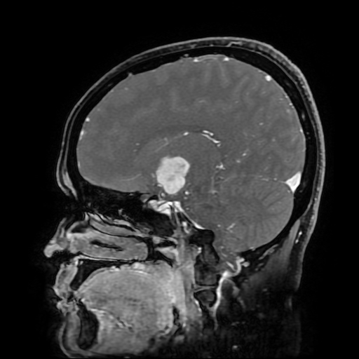File:Chordoid glioma of third ventricle (Radiopaedia 91612-109340 F 93).jpg