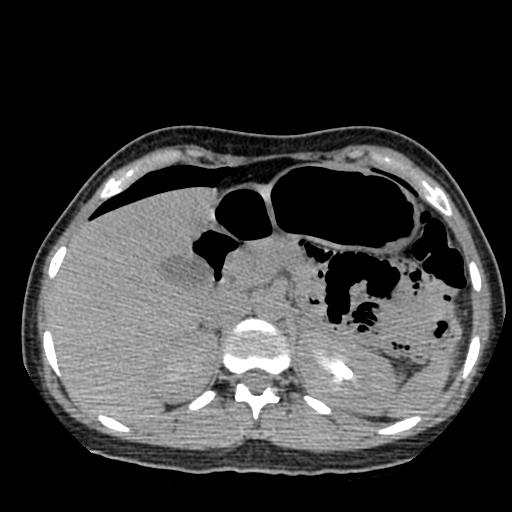 Choriocarcinoma of ovary with cerebral and pulmonary metastases (Radiopaedia 25983-26119 Axial non-contrast 102).jpg