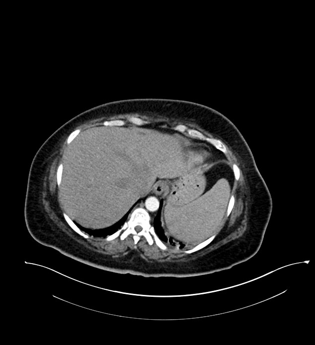 Chromophobe renal cell carcinoma (Radiopaedia 84239-99519 B 10).jpg