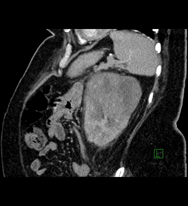 Chromophobe renal cell carcinoma (Radiopaedia 84239-99519 D 31).jpg