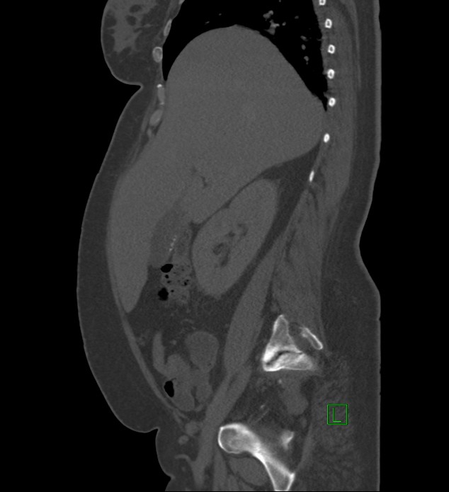 Chromophobe renal cell carcinoma (Radiopaedia 84239-99519 Sagittal bone window 74).jpg