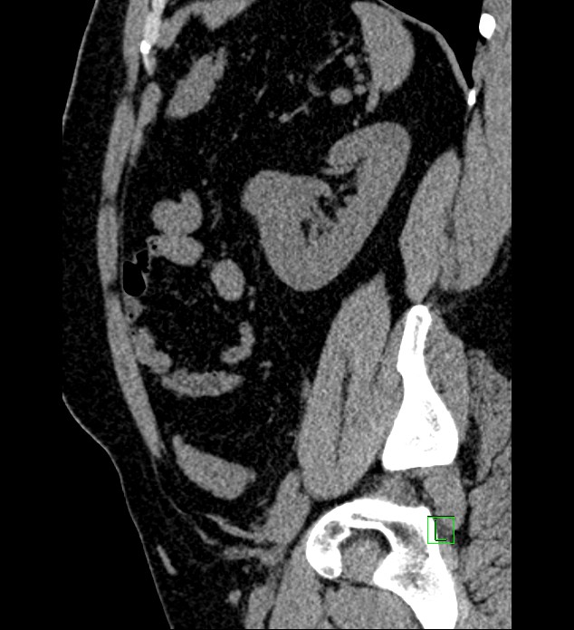 Chromophobe renal cell carcinoma (Radiopaedia 84286-99573 C 48).jpg
