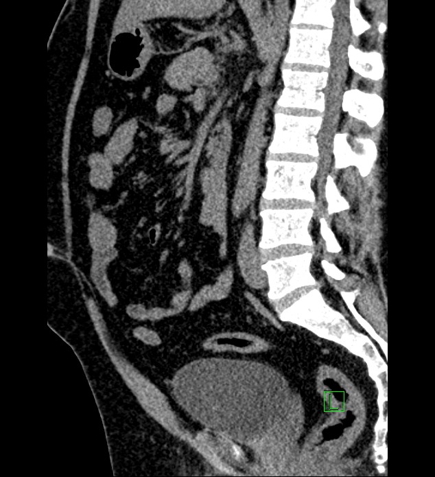 Chromophobe renal cell carcinoma (Radiopaedia 84286-99573 C 87).jpg