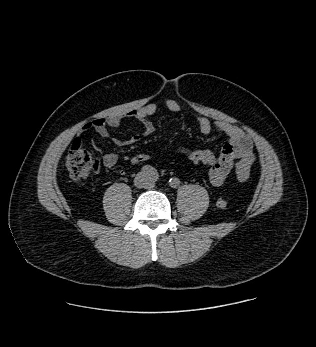 Chromophobe renal cell carcinoma (Radiopaedia 84337-99693 Axial non-contrast 95).jpg