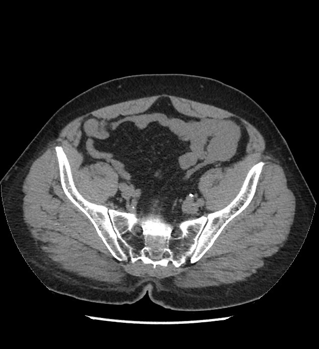 Chromophobe renal cell carcinoma (Radiopaedia 86879-103083 Axial non-contrast 100).jpg